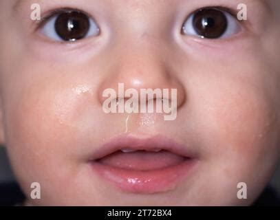 Bacterial diseases in the nose. Yellow snot from the nose of a little ...