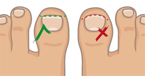 Ingrown toenail - Pedicure&Manicure