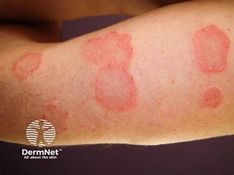 pityriasis rosea arms guess  diagnosis    psoriasis