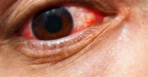 Alergie očí: 10 Osvědčených tipů jak zmírnit symptomy! • Senior Hub