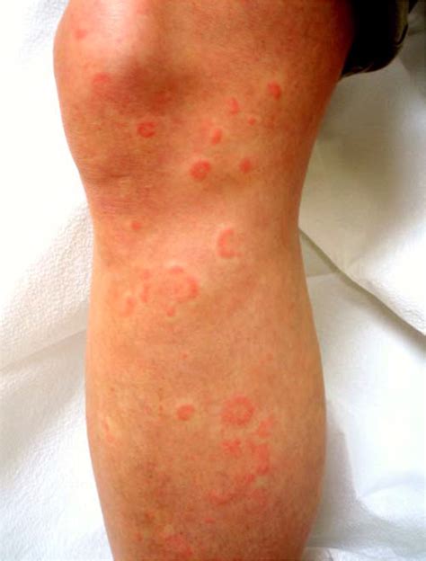 Erythema Multiforme: Recognition and Management | AAFP