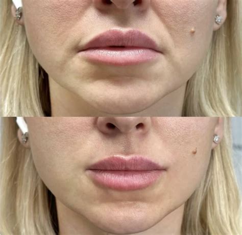 nasolabial fold filler london cost  treatments
