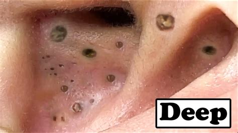Unbelievable Blackhead Removal 2024: The Year's Biggest Breakthrough - ei9aaeg