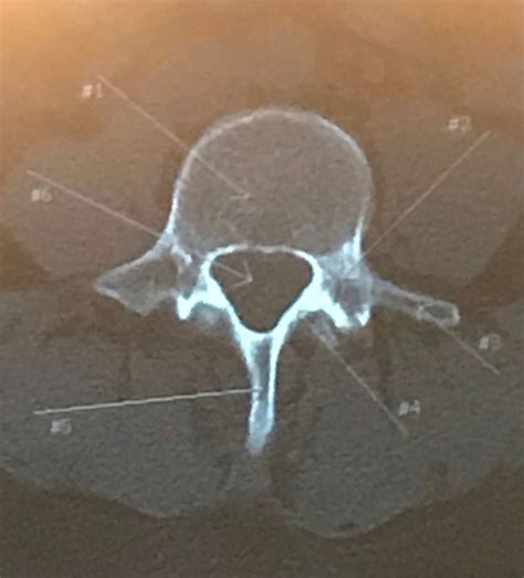ct spine anatomy  diagram quizlet