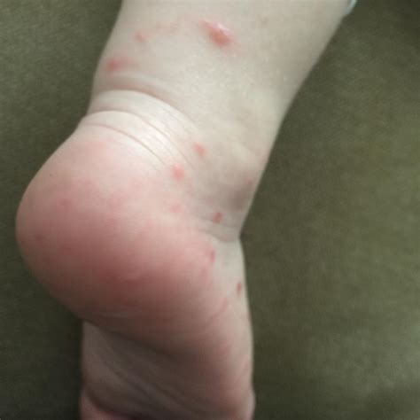 Spotting Hand Foot Mouth Disease