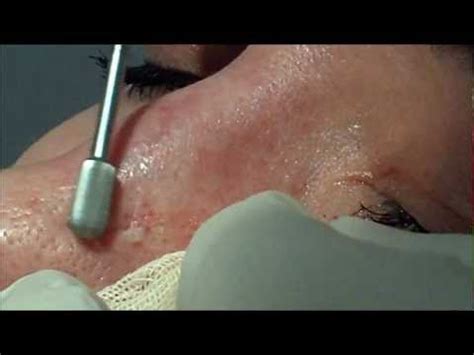 BELARUS DERMABRASION FOR SCAR ON NOSE - YouTube