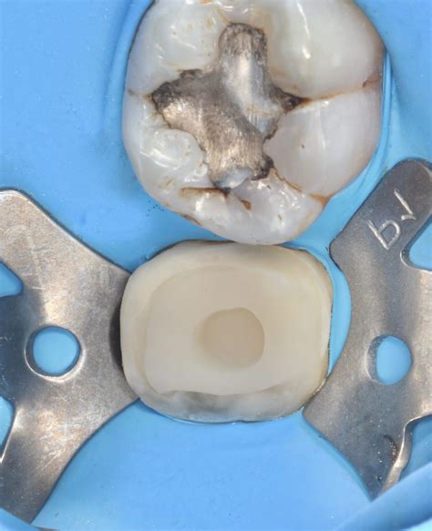 advice    treat cavities   bone level myzerodonto