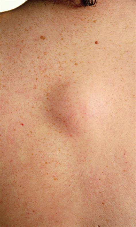 small ball  lump  skin  rodney sampson blog