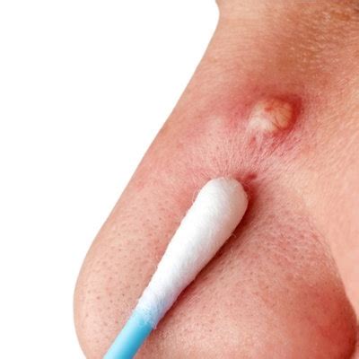 boils dermatology associates