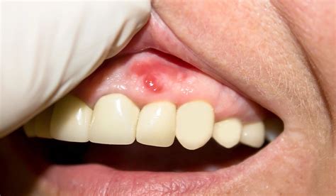 Gum Boils: What They Are And How To Treat Them, 52% OFF