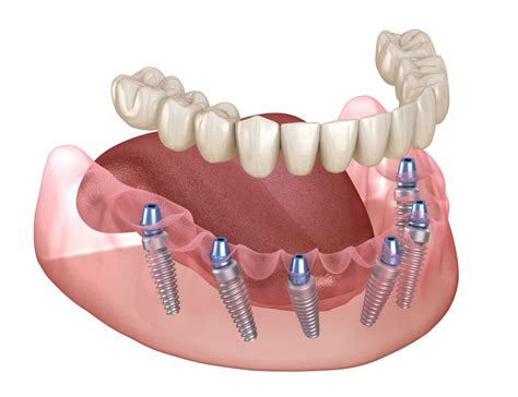 Full Mouth Dental Implants: Restoring Functionality And Boosting