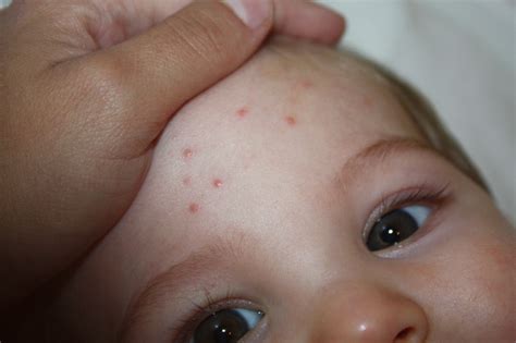Как проявляется ветрянка у детей: симптомы, фото начальной стадии