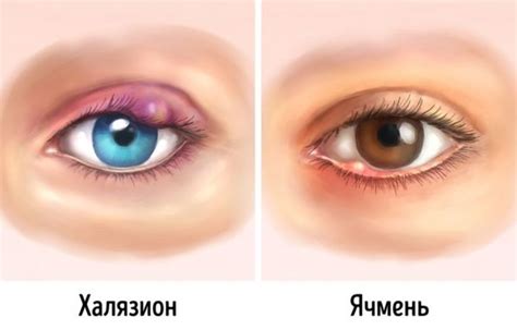 Ячмень. Причины, виды, лечение и осложнения после него