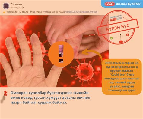 “Омикрон”-ы үед арьсан дээр илрэх зургаан шинж тэмдэг гэх мэдээлэл # ...