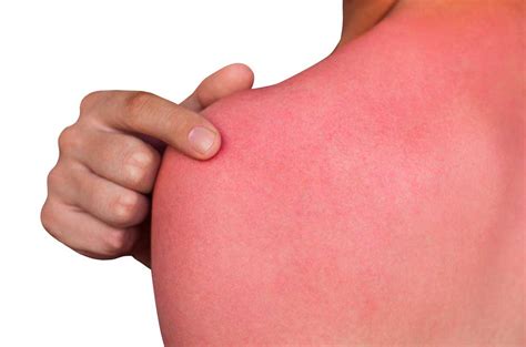 Sunburn definition and meaning | Collins English Dictionary