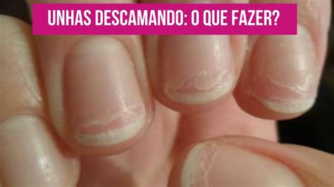 Unhas Descamando O Que Fazer - UNHAS DESCAMANDO: E AGORA? CAUSAS E O QUE FAZER - YouTube