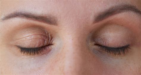 Eyelid Dermatitis: Types, Causes, Symptoms, and Treatment