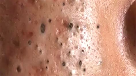 Blackheads @quyettranofficial3246 - YouTube