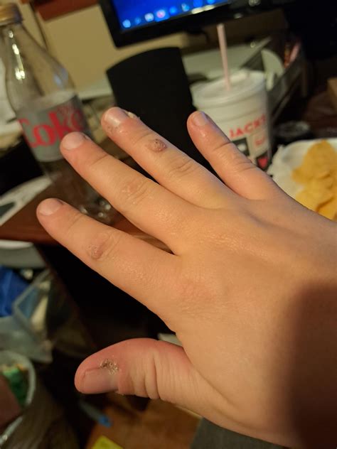 boyfriend has warts all over his hands and has tried everything
