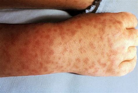 Herpangina Symptoms, Treatments, Home Remedies