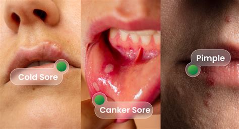 cold sore treatment  dentist appointment greenwoods