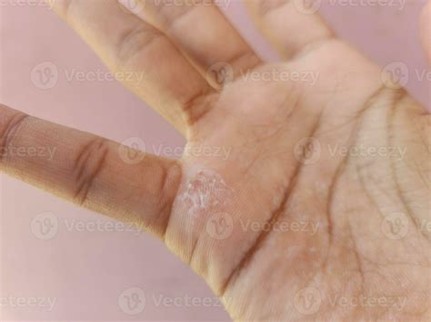 calluses hands. peeling and wrinkled 32044712 Stock Photo at Vecteezy