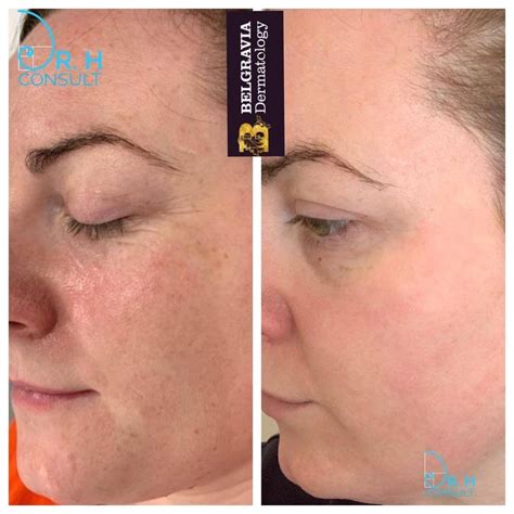 sciton halo bbl london surrey uk dr  consult