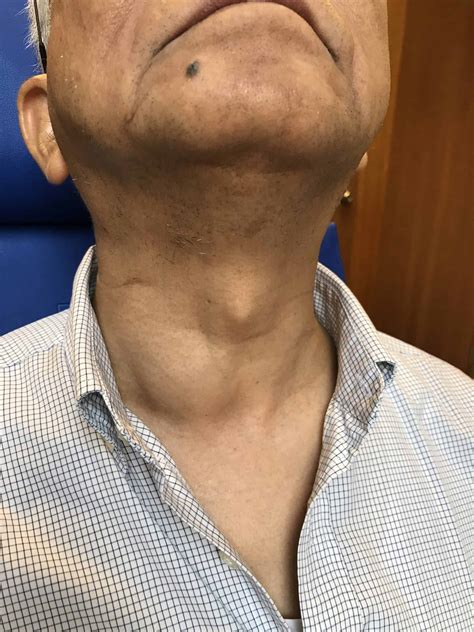 Left Side Neck Lump – What Is A Lump On My Neck – REMOEQ