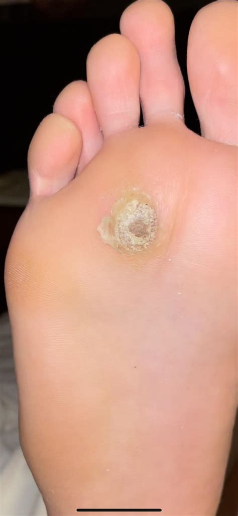 Wart. I’ve tried everything. It has been a year : r/medical_advice