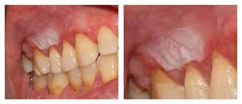 Ferida Branca Na Gengiva - LESÃO BRANCA BOCA - Clínica Dentária Jardim dos Arcos