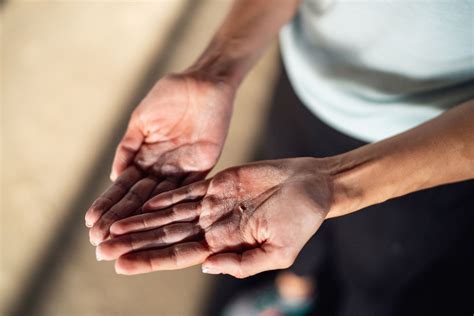 6 Reasons for Calluses on Hands and Feet and How to Treat Them