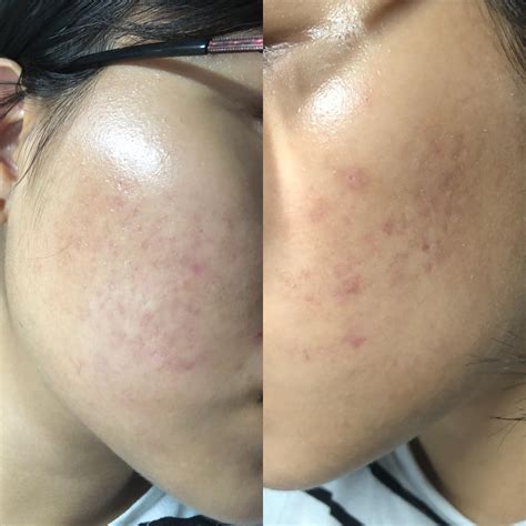 [skin concerns] help with scarring : r/SkincareAddiction