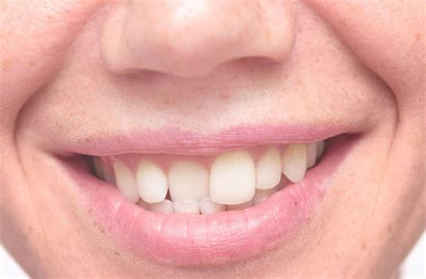 How to Fix Crooked Teeth | Braces Haven Orthodontic Blog