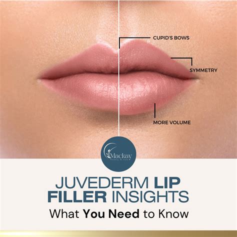 juvederm lip cheek filler treatments mackay med spa st pete