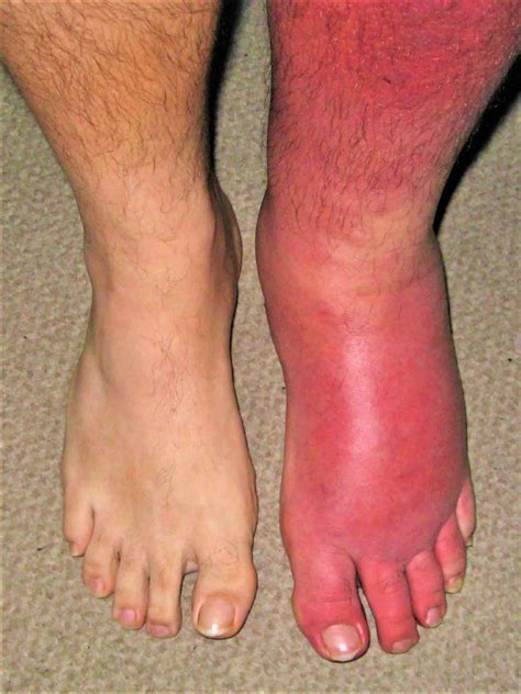 Peripheral Oedema and Ankle Swelling History – MLA Medics