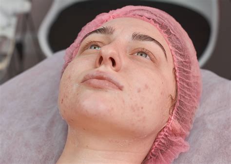 Laser Skin Rejuvenation | Dripclub