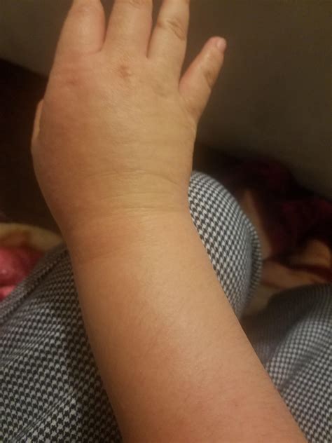 my wrists and hands are swollen, is there anything that helps with