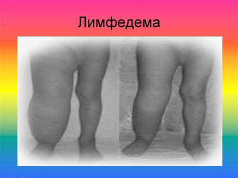 Лимфа айналымының бұзылуы: лимфа түзілуінің бұзылуы. Лимфедема ...
