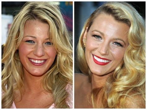 Teeth Whitening Chart | Celebrities with veneers, Celebrity teeth, Veneers teeth