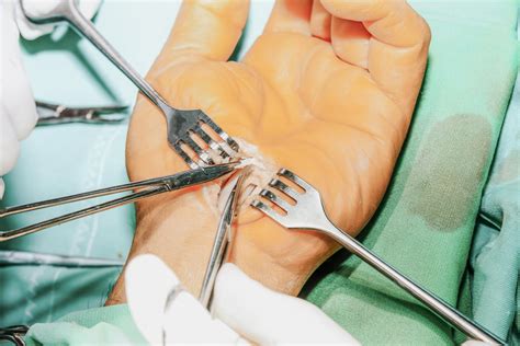 After Carpal Tunnel Surgery Recovery Time