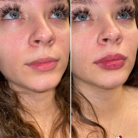 face filler near me 2