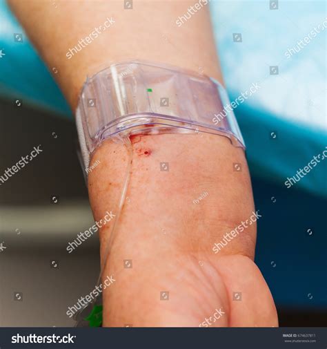 10 Stent Placement With Doctor Images, Stock Photos & Vectors