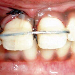 Splinting of the involved tooth | Download Scientific Diagram