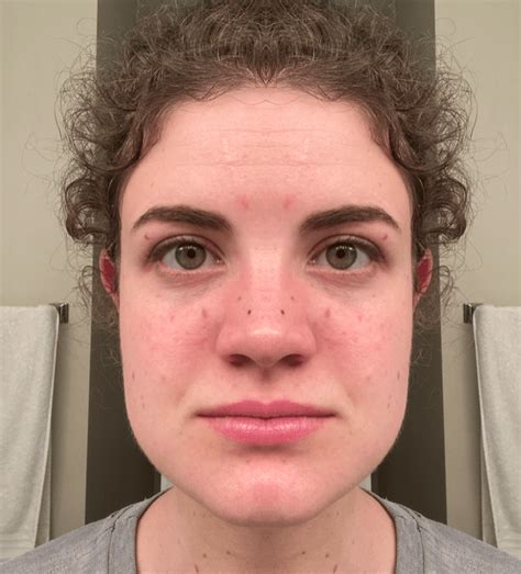 how to fix facial asymmetry from chewing on one side