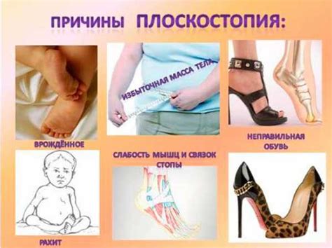 Как выглядит плоскостопие 3 степени – Плоскостопие 1-й, 2-й, 3-й, 4-й ...