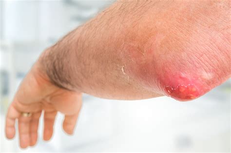 boils-carbuncle-on-elbow