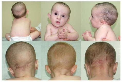 Torticollis & Plagiocephaly Pediatric PT — Brill Physical Therapy