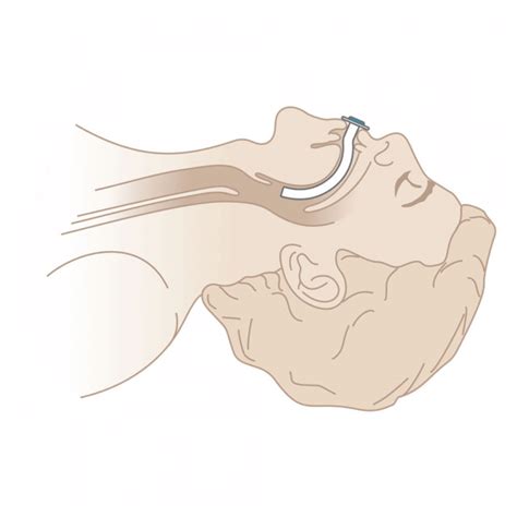 Воздуховод орофарингеальный одноразовый Гведела | Medtronic | НДА
