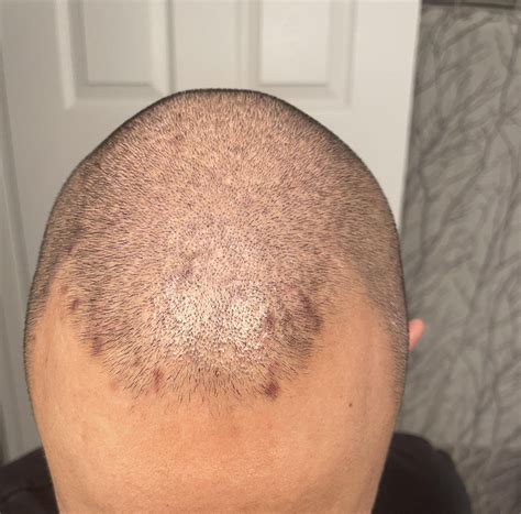 Folliculitis on Head : r/Folliculitis