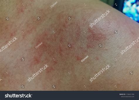 red rash  skin stock photo  shutterstock